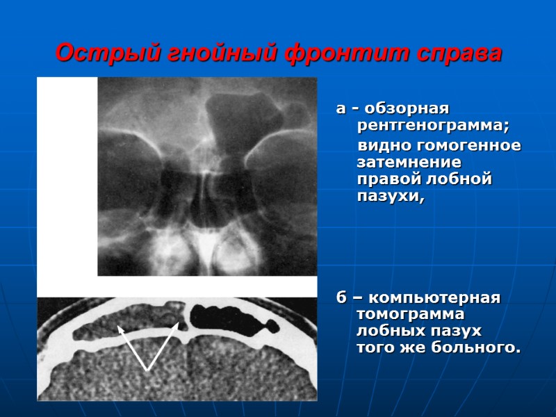 Острый гнойный фронтит справа а - обзорная рентгенограмма;     видно гомогенное